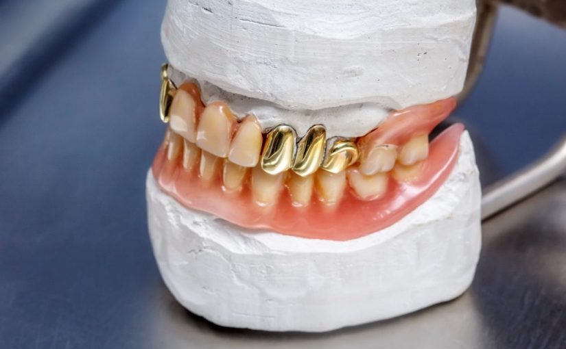 دو دندان مصنوعی طلا در کنار سایر دندان‌ها